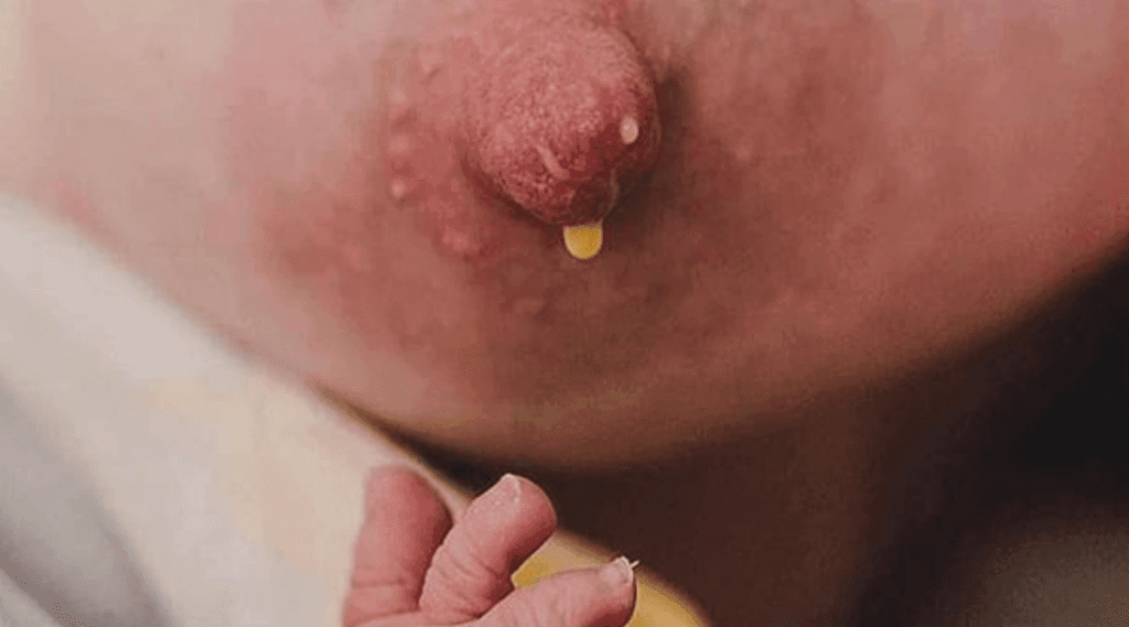 Tắc tuyến vú - vấn đề thường gặp khi nuôi con bằng sữa mẹ