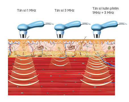 Siêu âm trị liệu trị tắc sữa