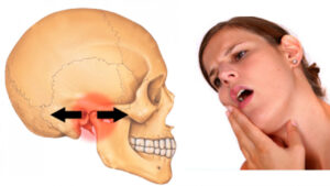 tình trạng tổn thương xương hàm ở vùng khớp thái dương hàm 