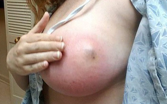 hình ảnh vú người phụ nữ viêm tắc nặng