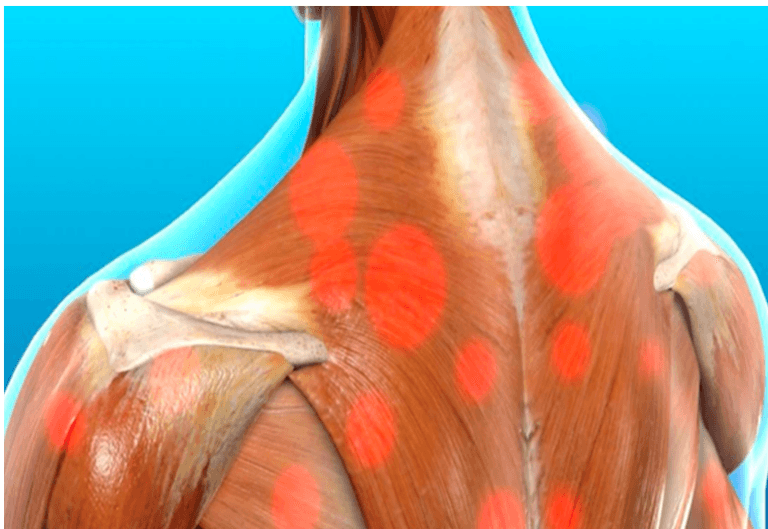 Trigger point