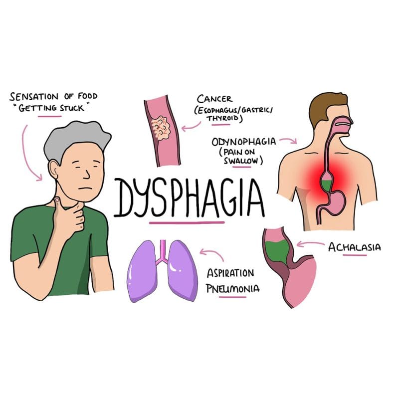 HÌnh minh họa cho các triệu chứng gây ra rối loạn nuốt