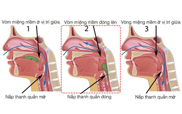 Quá trình nuốt bình thường bao gồm 3 giai đoạn Giai đoạn miệng, giai đoạn hầu, giai đoạn thực quản