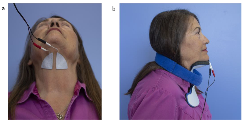 dán điện cực vùng trên xương móng điều trị rối loạn giai đoạn hầu họng trong điều trị rối loạn nuốt trong tai biến mạch máu não