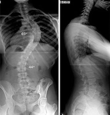 cột sống bị cong vẹo