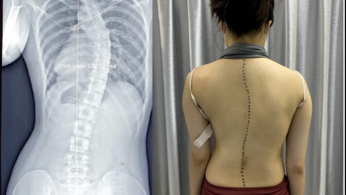 Cột sống lưng bị cong 1 veo cot song