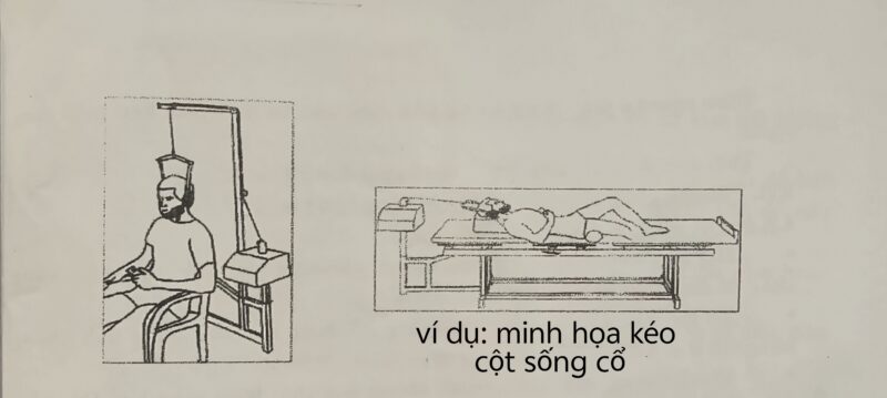 minh họa kéo giãn cột sống cổ trong phương pháp kéo cột sống cổ lưng