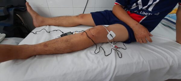 Điện xung trị liệu có tác dụng gì? Cách sử dụng đúng-hiệu quả 2025