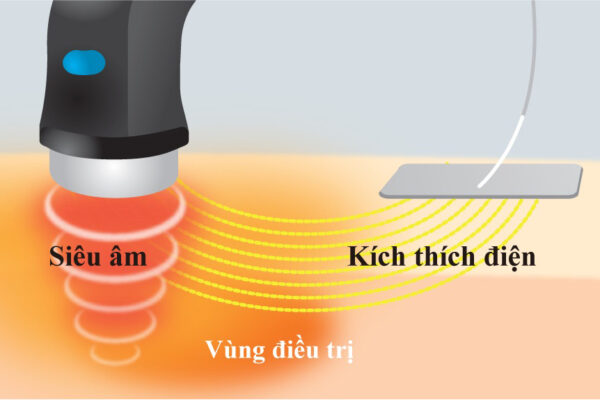 sóng siêu âm điều trị