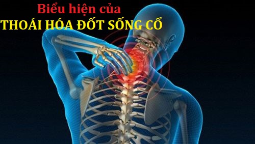 vật lý trị liệu thoái hóa cột sống cổ