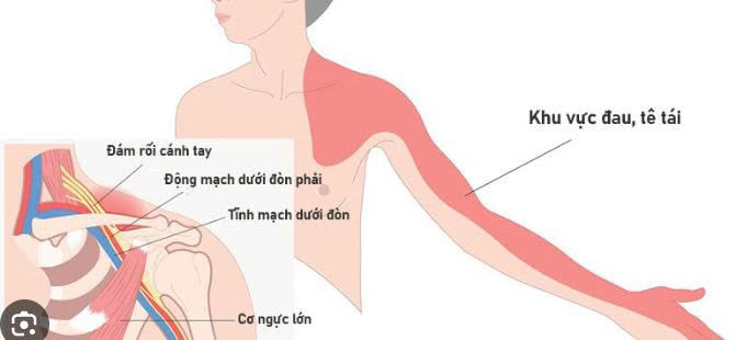 hội chứng chèn ép dưới đòn
