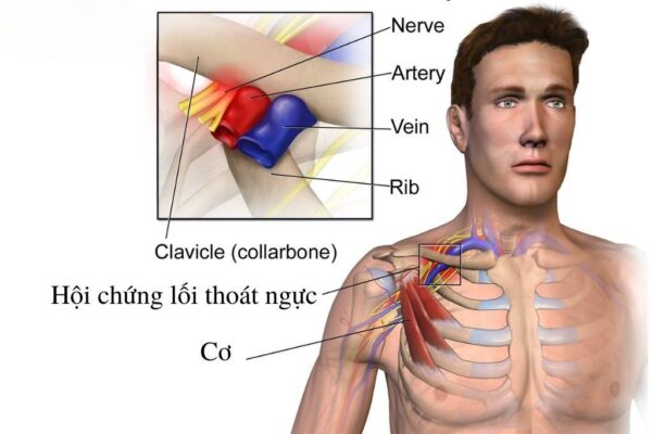 hội chứng chèn ép dưới đòn