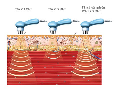 máy siêu âm triệu liệu có tác dụng phụ không?
