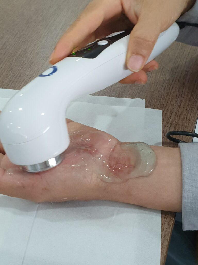 Điều trị cùng máy siêu âm trị liệu cầm tay UP2