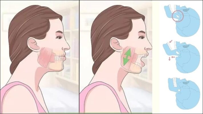 trị viêm khớp thái dương hàm bằng vật lý trị liệu